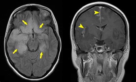 hsv encephalitis radiology